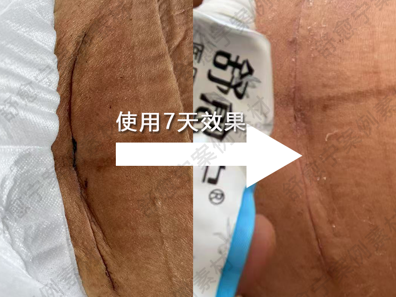 剖腹产案例